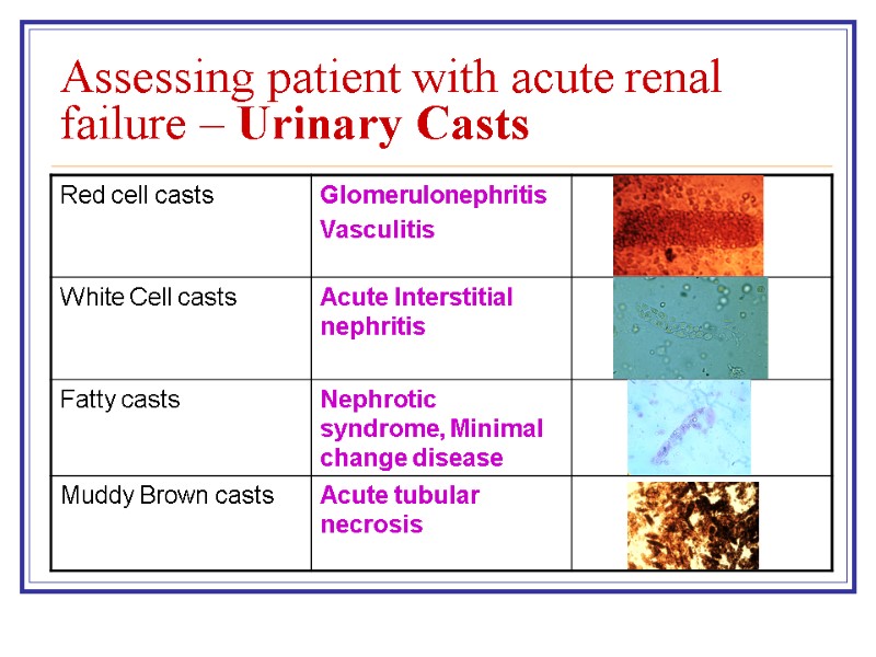 Assessing patient with acute renal failure – Urinary Casts